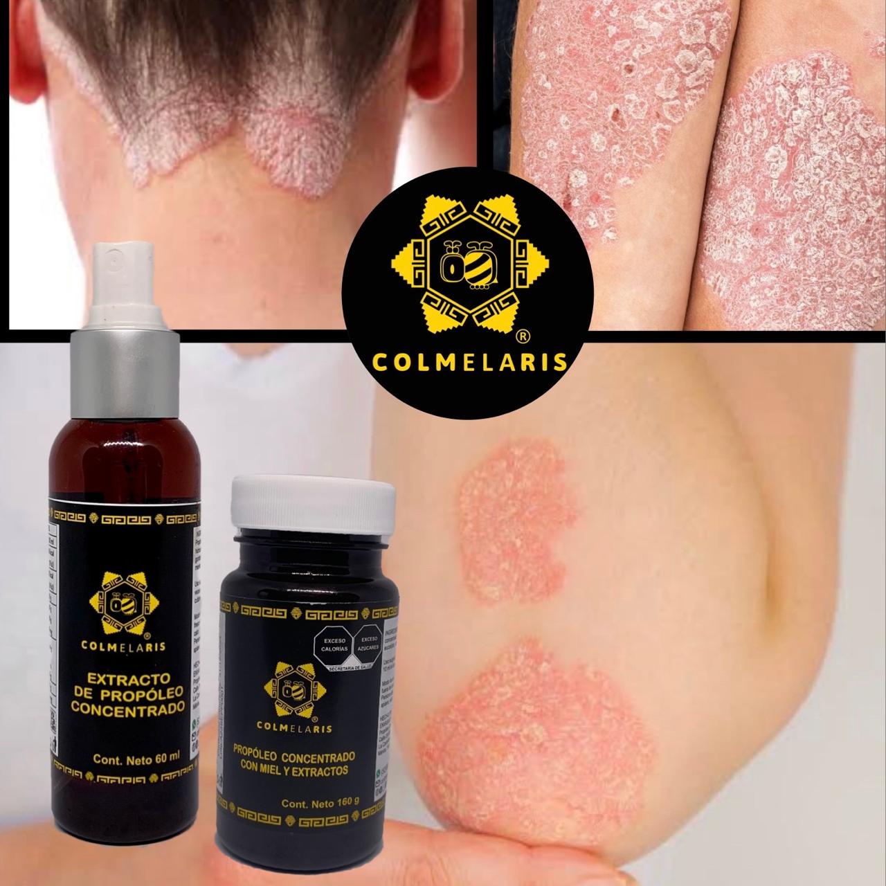 psoriasis cura con propoleo